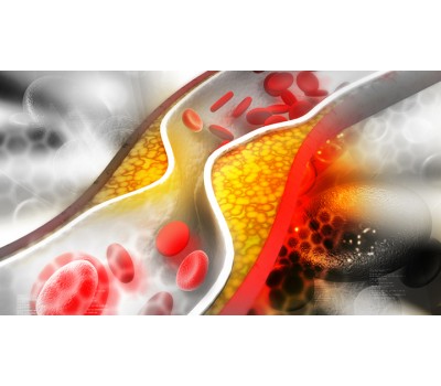 Cholesterol Management